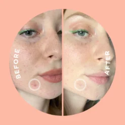 Killa Kit Deep Zit Microdart Patch -Clinique || Molton Brown || Fresh Sales Store global images 9353371000003 3