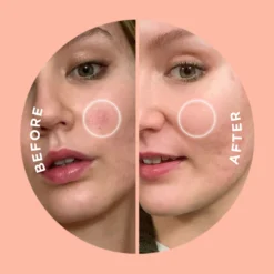 Killa Kit Deep Zit Microdart Patch -Clinique || Molton Brown || Fresh Sales Store global images 9353371000003 4