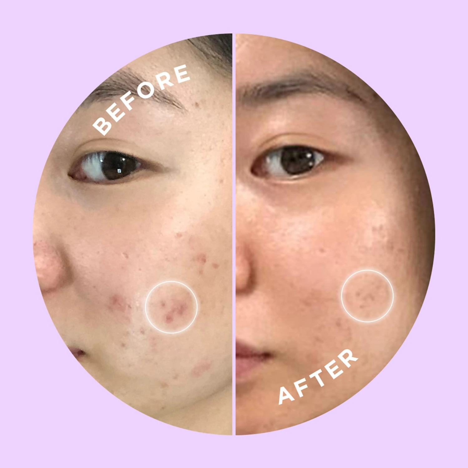 Hyperfade Dark Spot Microdart Patch 2 Hyperfade Dark Spot Microdart Patch - Image 2