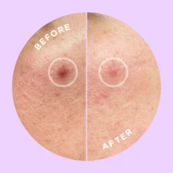 Hyperfade Dark Spot Microdart Patch 7 Hyperfade Dark Spot Microdart Patch -Clinique || Molton Brown || Fresh Sales Store global images 9353371000058 3