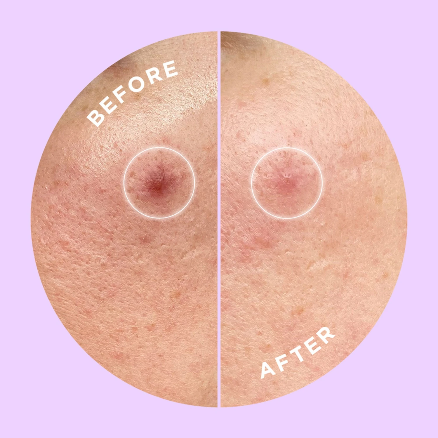 Hyperfade Dark Spot Microdart Patch 3 Hyperfade Dark Spot Microdart Patch - Image 3